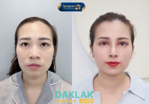 Hình ảnh khách hàng trước và sau khi thực hiện nâng mũi tại Viện Thẩm Mỹ Kangnam Buôn Ma Thuột, đường nét gương mặt hài hòa và sống mũi cao tự nhiên.