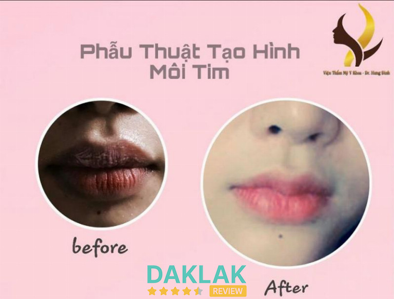 Kết quả phẫu thuật tạo hình môi tim tại Thẩm Mỹ Viện Linh Linh Trang, đôi môi sắc nét và hài hòa hơn so với ban đầu.