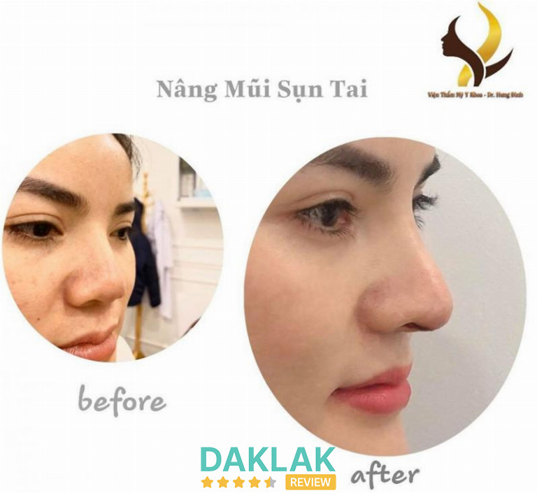 Hình ảnh trước và sau khi nâng mũi sụn tai tại Thẩm Mỹ Viện Linh Linh Trang, dáng mũi cao tự nhiên và cân đối hơn.