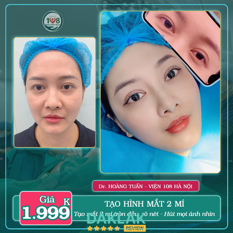 Kết quả tạo hình mắt 2 mí tại Viện Thẩm Mỹ 108 Buôn Ma Thuột, mí mắt tròn đều và đường nét rõ ràng sau thực hiện.