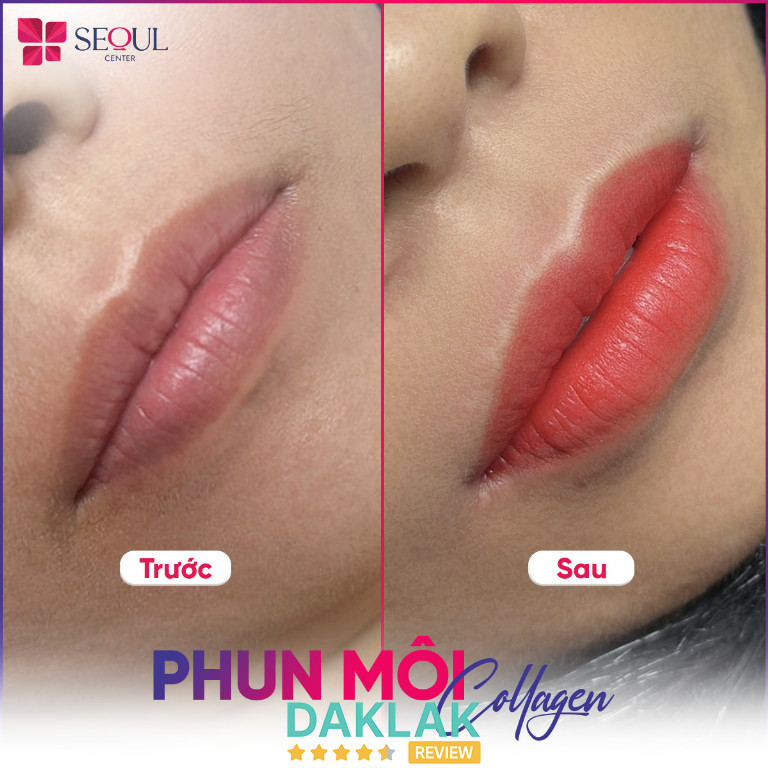 Kết quả phun môi Collagen tại Seoul Center Buôn Ma Thuột, đôi môi lên màu tươi tắn và sắc nét hơn so với ban đầu.